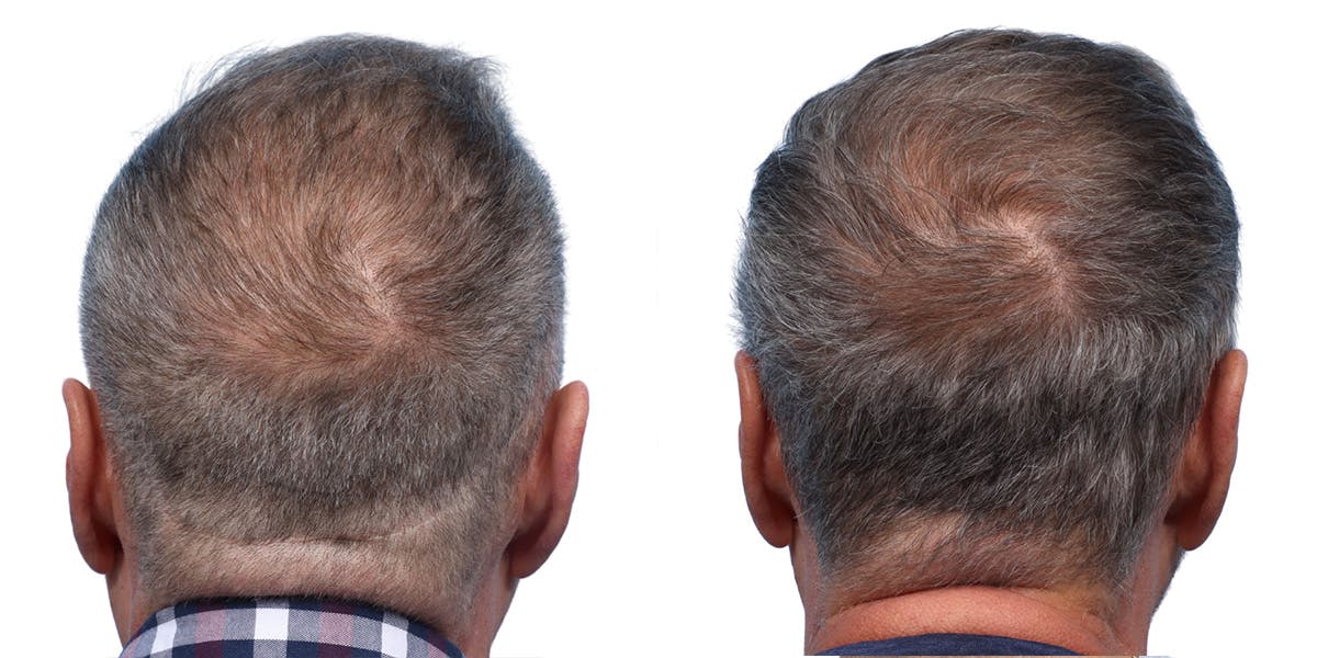 FUE Hair Transplant Before & After Gallery - Patient 200067 - Image 3