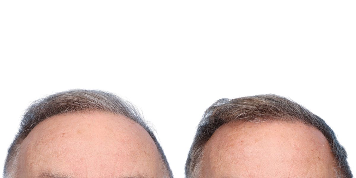 FUE Hair Transplant Before & After Gallery - Patient 200067 - Image 1