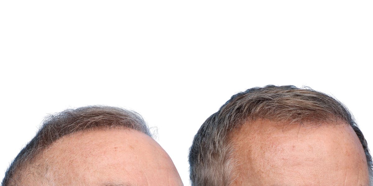 FUE Hair Transplant Before & After Gallery - Patient 200067 - Image 4