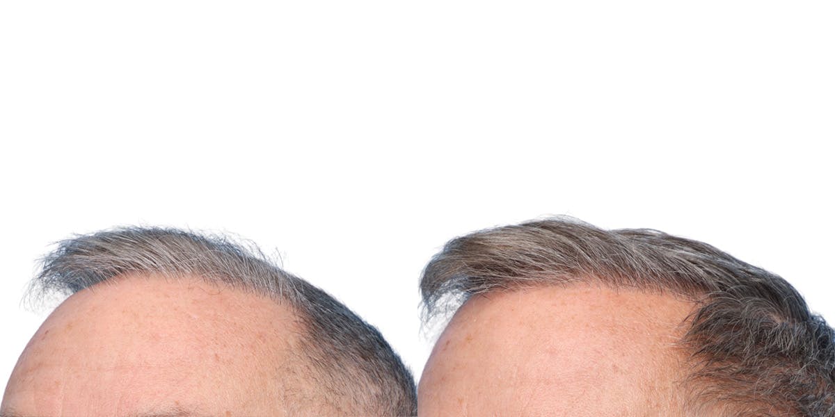 FUE Hair Transplant Before & After Gallery - Patient 200067 - Image 5