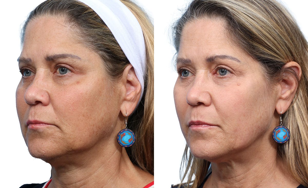 Chemical Peels Before & After Gallery - Patient 157673 - Image 2