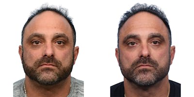 FUE Hair Transplant Before & After Gallery - Patient 240140 - Image 1