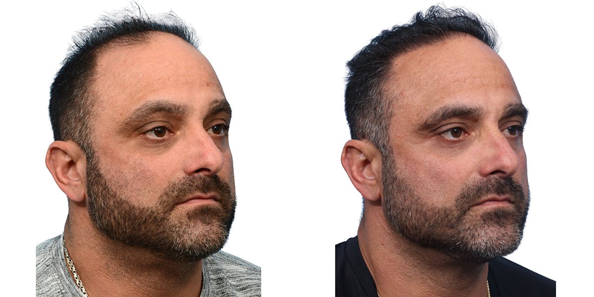 FUE Hair Transplant Before & After Gallery - Patient 240140 - Image 2