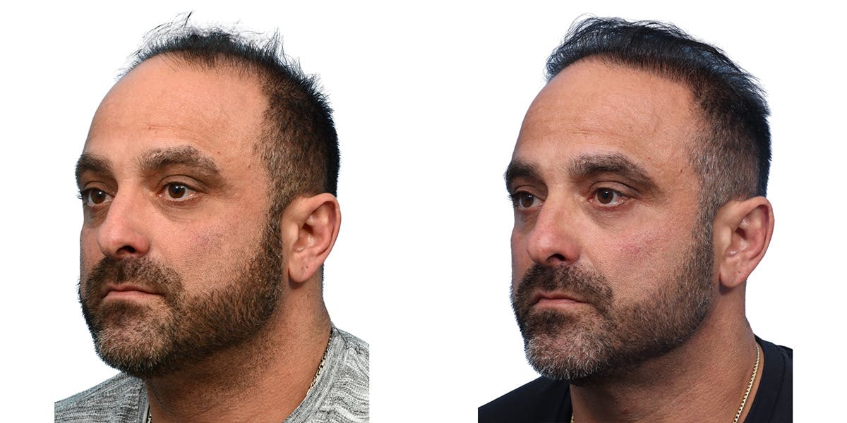FUE Hair Transplant Before & After Gallery - Patient 240140 - Image 3