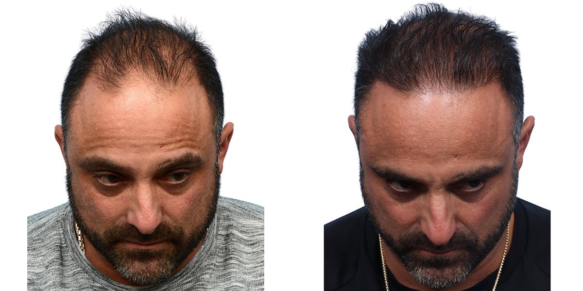 FUE Hair Transplant Before & After Gallery - Patient 240140 - Image 4
