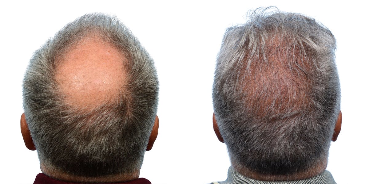 FUE Hair Transplant Before & After Gallery - Patient 361286 - Image 1
