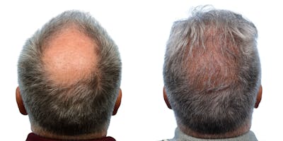 FUE Hair Transplant Before & After Gallery - Patient 361286 - Image 1