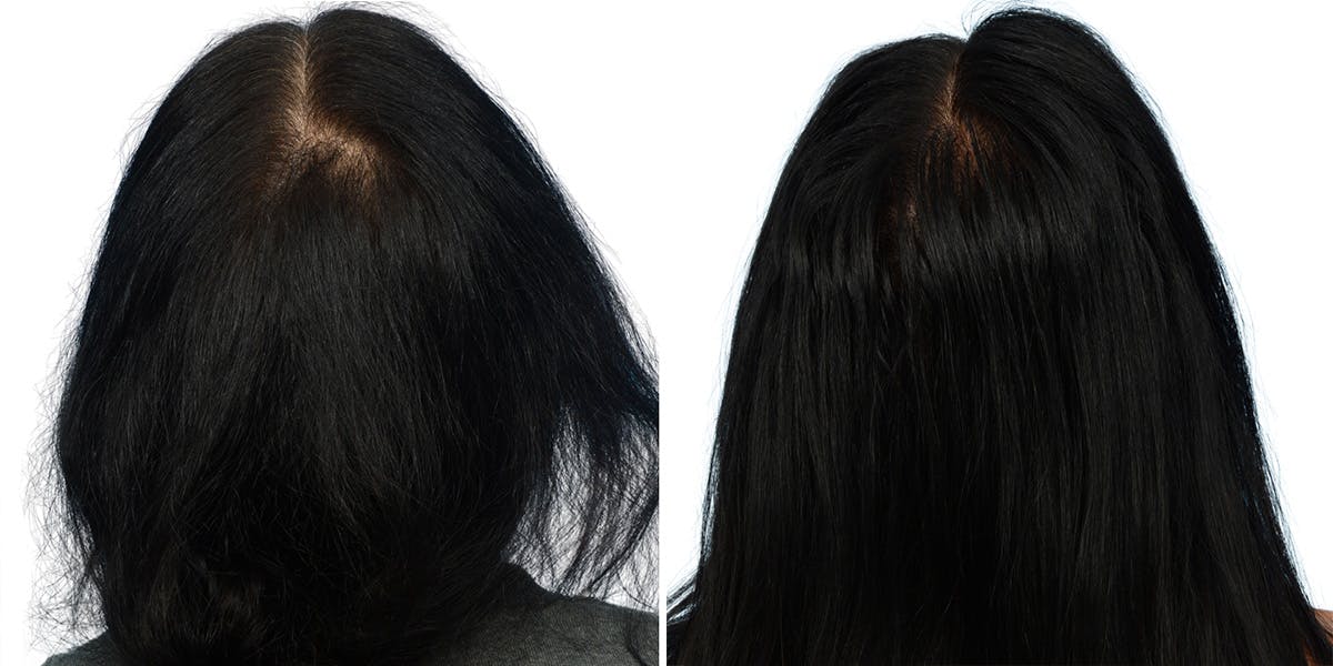 Platelet-Rich-Plasma Before & After Gallery - Patient 231477 - Image 2