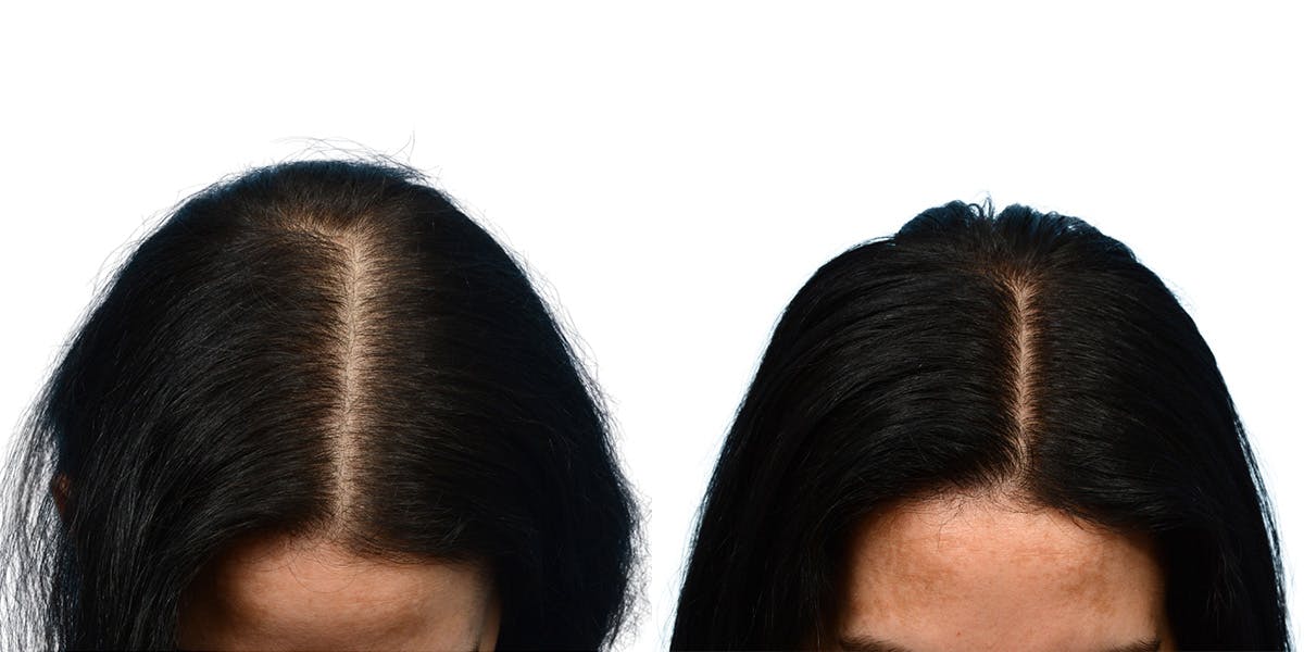 Platelet-Rich-Plasma Before & After Gallery - Patient 231477 - Image 1