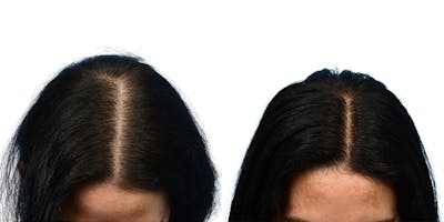Platelet-Rich-Plasma Before & After Gallery - Patient 231477 - Image 1