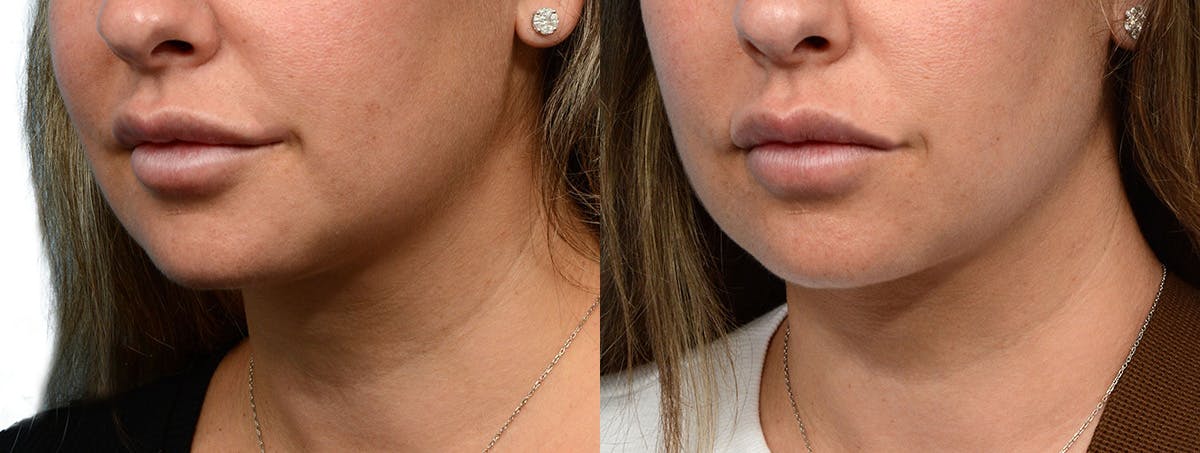 Ultherapy® Before & After Gallery - Patient 227773 - Image 3