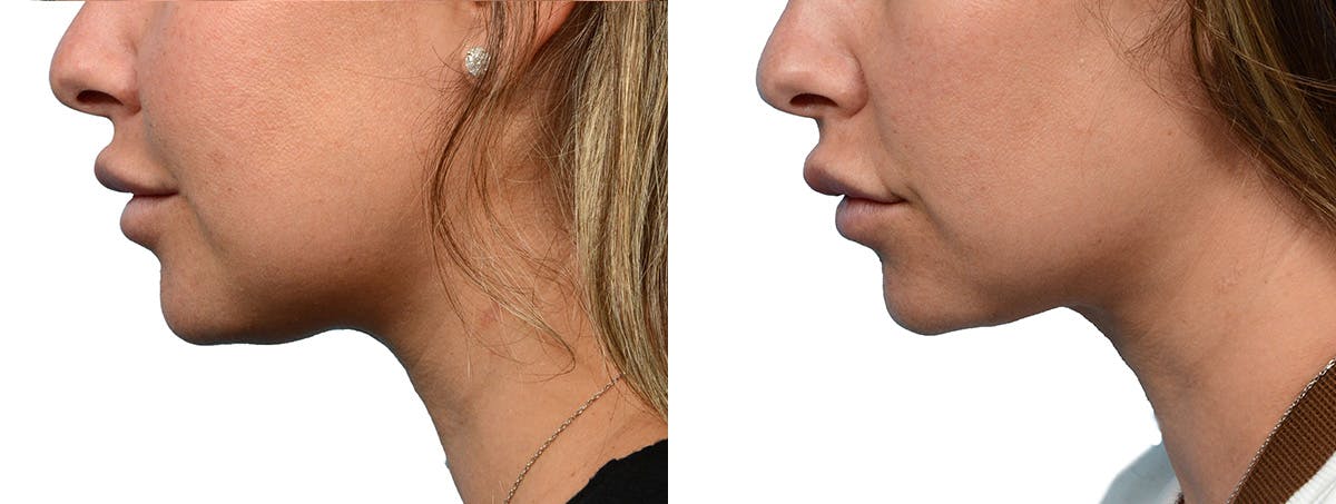 Ultherapy® Before & After Gallery - Patient 227773 - Image 4