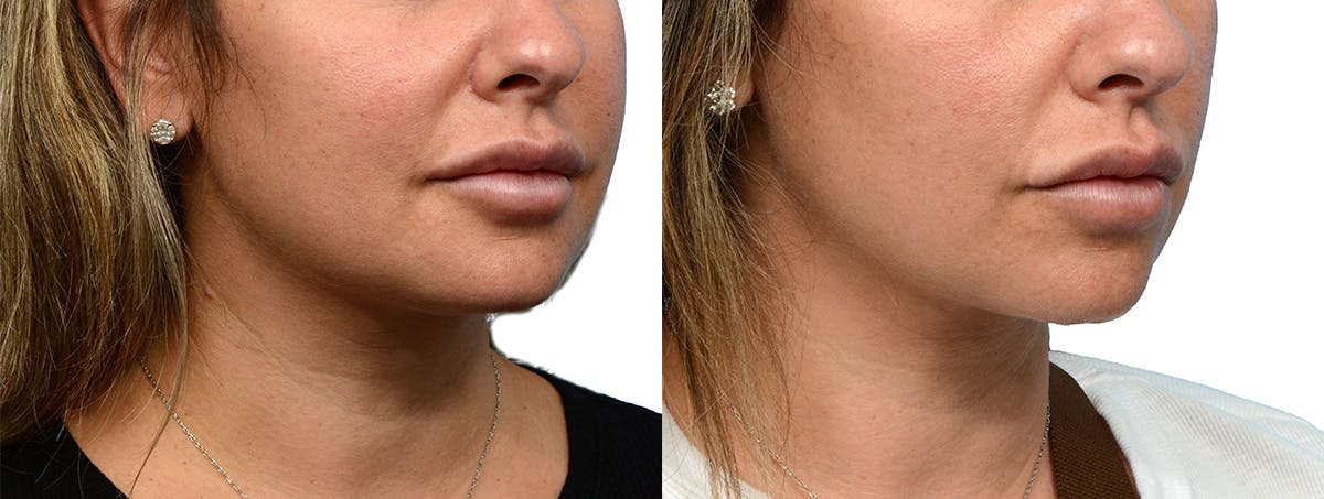 Ultherapy® Before & After Gallery - Patient 227773 - Image 1