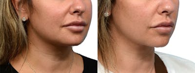 Ultherapy® Before & After Gallery - Patient 227773 - Image 1