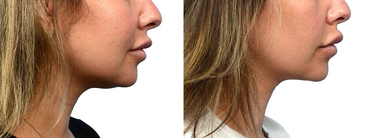Ultherapy® Before & After Gallery - Patient 227773 - Image 2