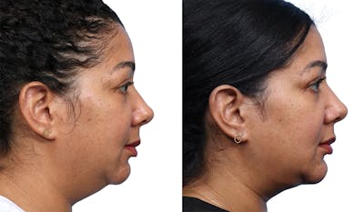 Chin Augmentation Before & After Gallery - Patient 368933 - Image 1