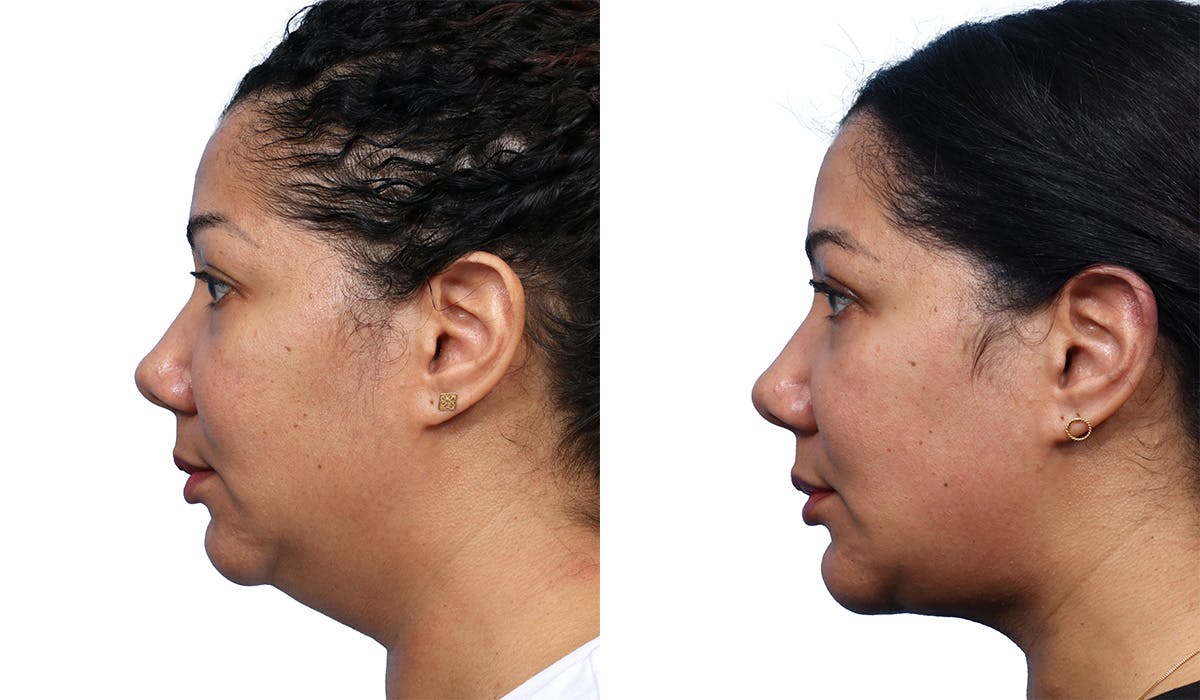 Chin Augmentation Before & After Gallery - Patient 368933 - Image 2