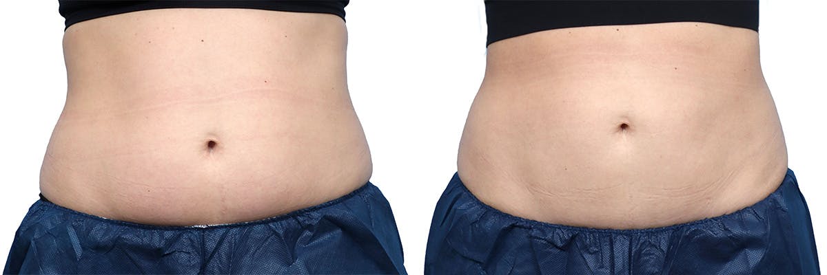CoolSculpting® Before & After Gallery - Patient 195813 - Image 1