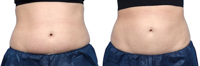CoolSculpting® Before & After Gallery - Patient 195813 - Image 1