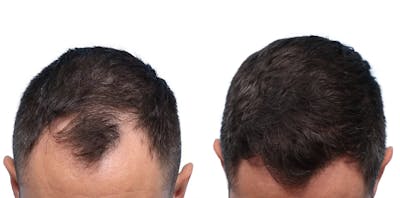 FUE Hair Transplant Before & After Gallery - Patient 276254 - Image 1