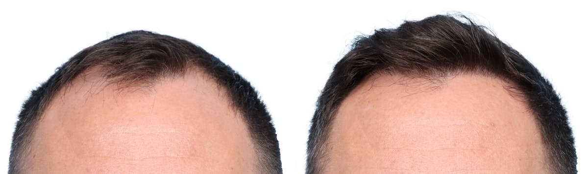 FUE Hair Transplant Before & After Gallery - Patient 276254 - Image 2