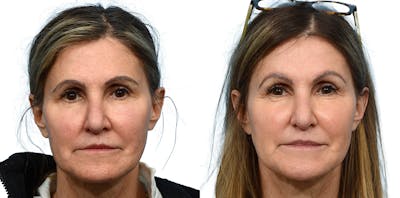 Brow Lift Before & After Gallery - Patient 338749 - Image 1