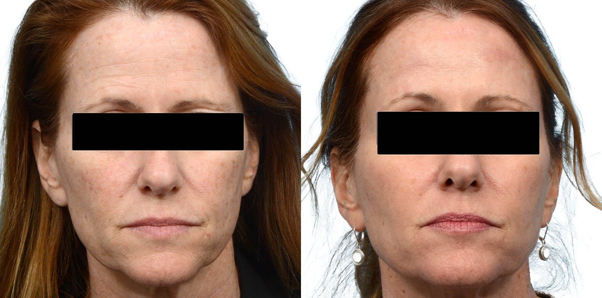 Brow Lift Before & After Gallery - Patient 111500 - Image 1