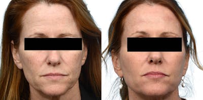 Brow Lift Before & After Gallery - Patient 111500 - Image 1