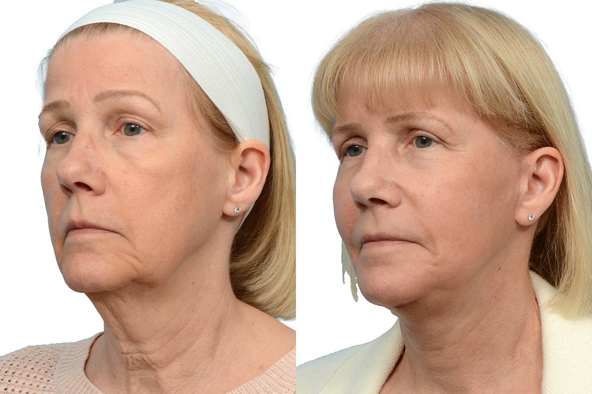 Deep Plane Facelift Before & After Gallery - Patient 333849 - Image 2