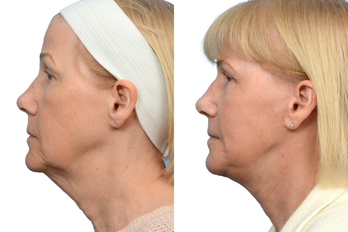 Deep Plane Facelift Before & After Gallery - Patient 333849 - Image 3