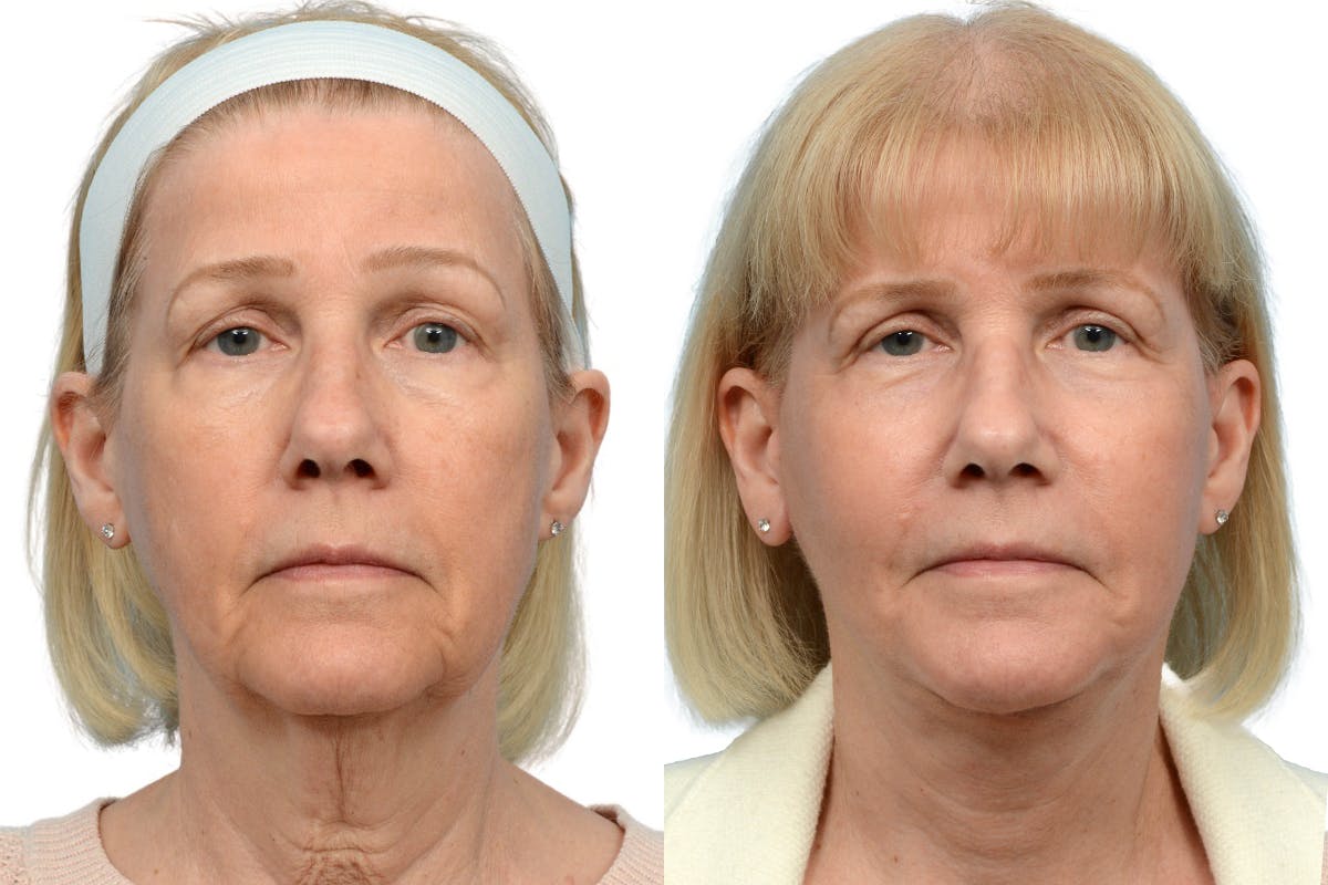 Deep Plane Facelift Before & After Gallery - Patient 333849 - Image 1