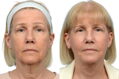 Deep Plane Facelift Before & After Gallery - Patient 333849 - Image 1