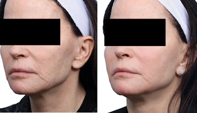 Cool Peel Before & After Gallery - Patient 855851 - Image 1