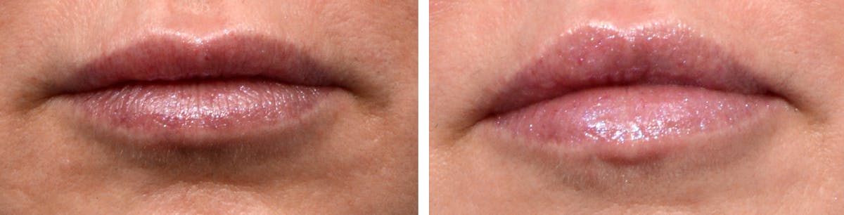 Lip Lift Before & After Gallery - Patient 207631 - Image 1