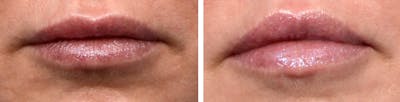 Lip Lift Before & After Gallery - Patient 207631 - Image 1