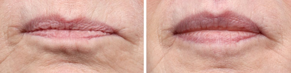 Lip Lift Before & After Gallery - Patient 415507 - Image 1