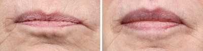 Lip Lift Before & After Gallery - Patient 415507 - Image 1