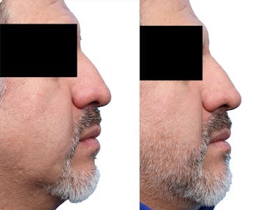 Non-Surgical Rhinoplasty Before & After Gallery - Patient 189267 - Image 1