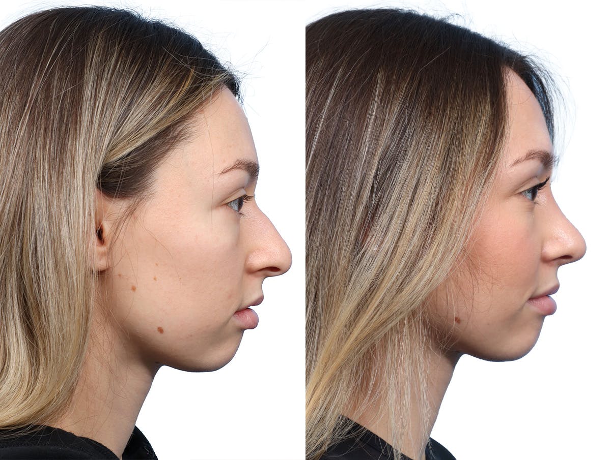 Rhinoplasty Before & After Gallery - Patient 246514 - Image 1