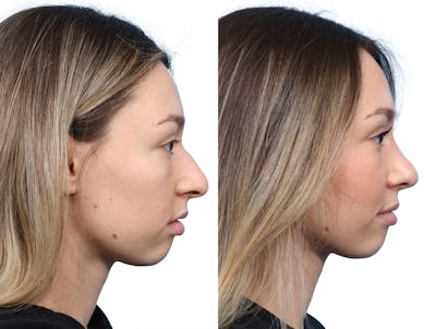 Rhinoplasty Before & After Gallery - Patient 246514 - Image 1