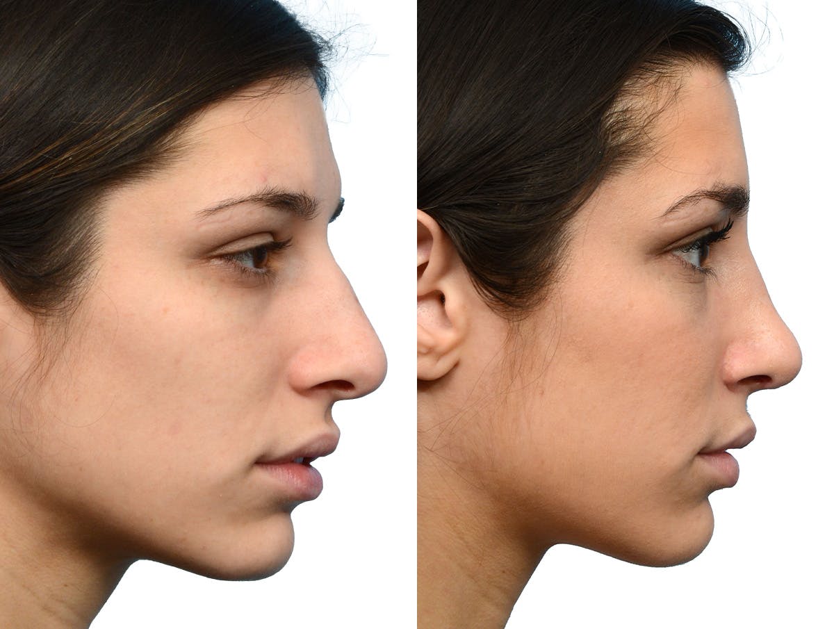 Rhinoplasty Before & After Gallery - Patient 366060 - Image 1