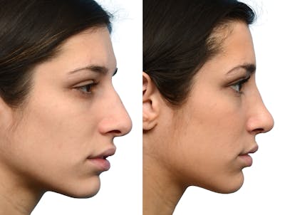Rhinoplasty Before & After Gallery - Patient 366060 - Image 1