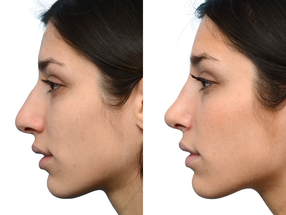 Rhinoplasty Before & After Gallery - Patient 366060 - Image 2