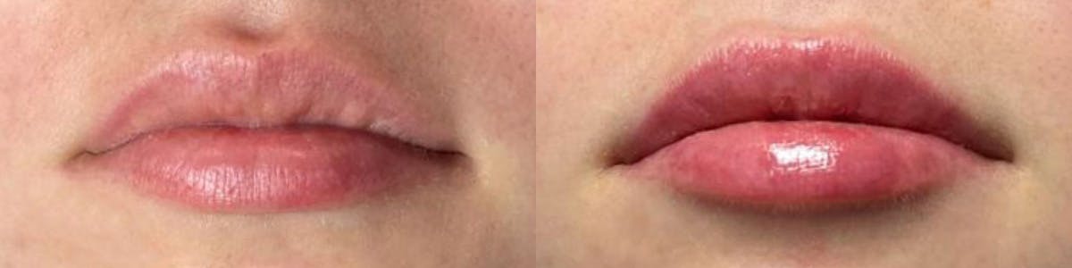 Lip Enhancement Before & After Gallery - Patient 423879 - Image 1