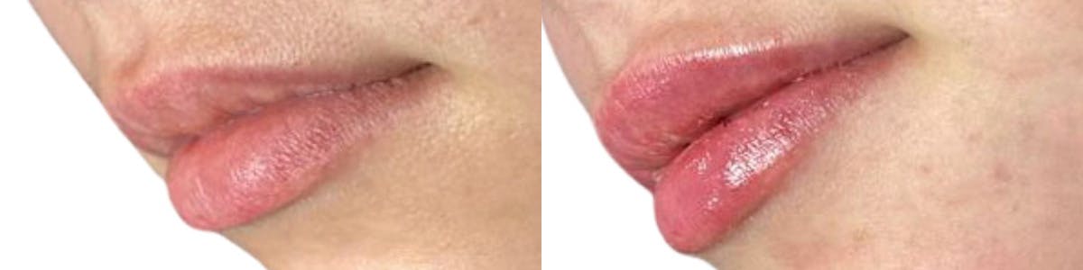 Lip Enhancement Before & After Gallery - Patient 423879 - Image 2