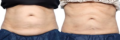CoolSculpting® Before & After Gallery - Patient 355366 - Image 1