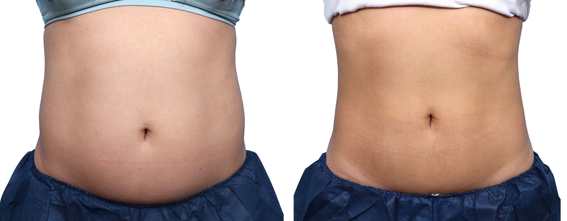 CoolSculpting® Before & After Gallery - Patient 718122 - Image 1