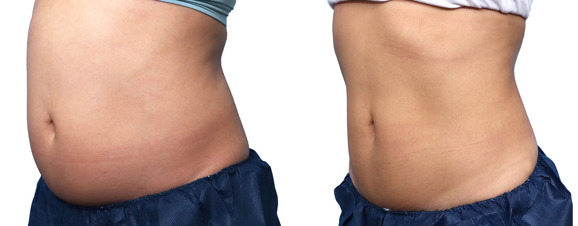 CoolSculpting® Before & After Gallery - Patient 718122 - Image 2