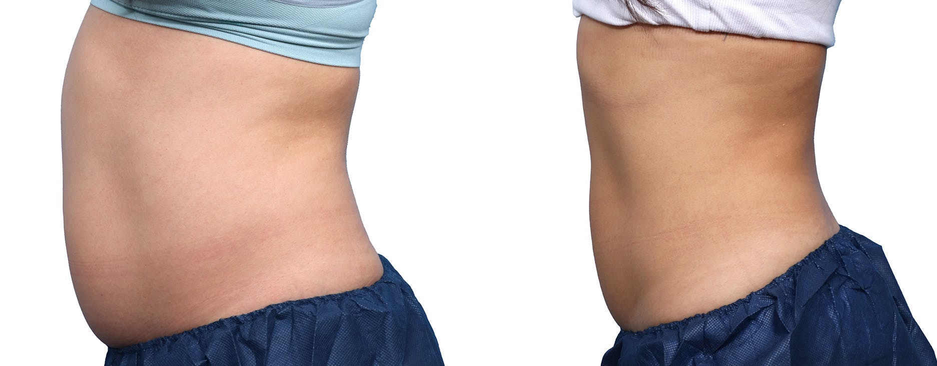 CoolSculpting® Before & After Gallery - Patient 718122 - Image 3