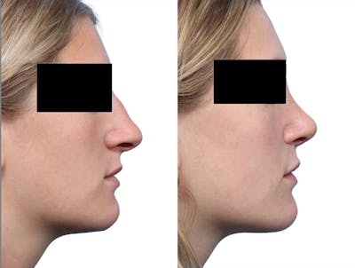 Rhinoplasty Before & After Gallery - Patient 369855 - Image 1